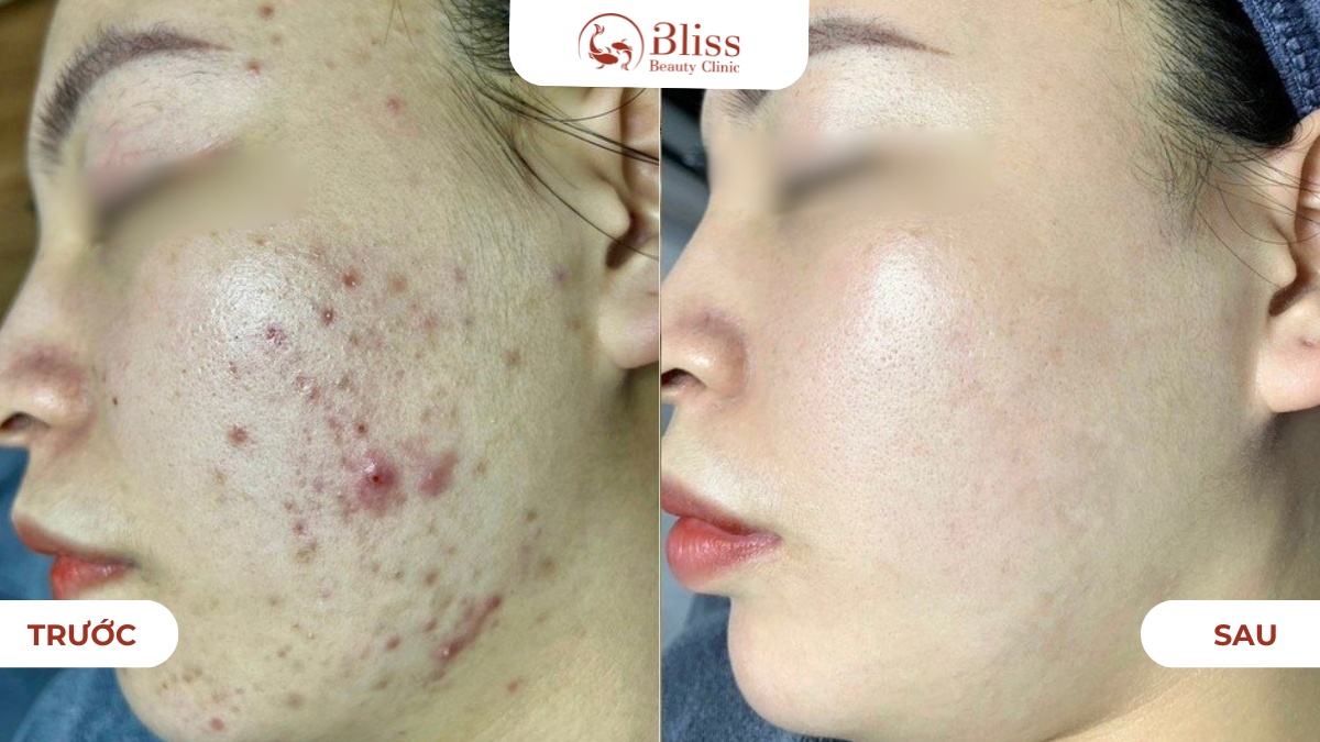 xử lý nhân mụn 15 bước chuẩn y khoa