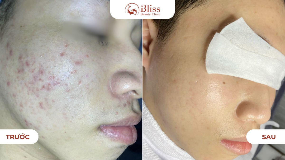 lấy nhân mụn dậy thì