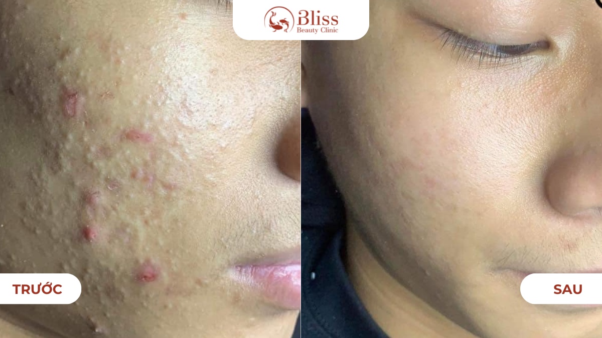lấy nhân mụn ẩn 15 bước chuẩn y khoa