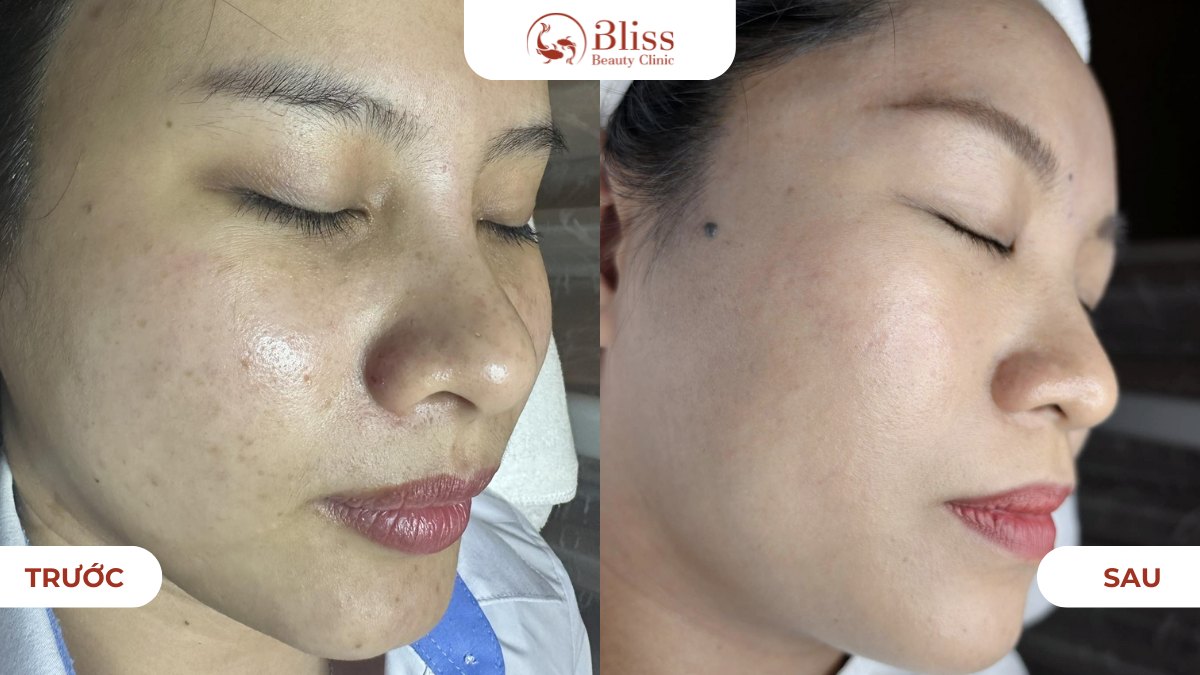 Peel da đất sét Clay Peel trắng sáng da