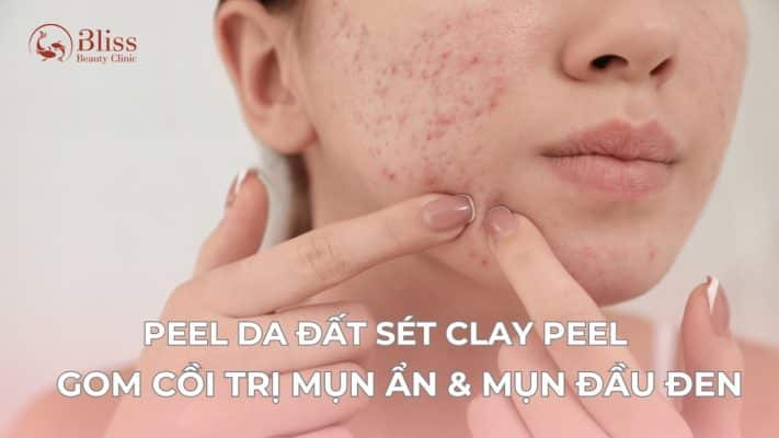 Peel da đất sét Clay Peel