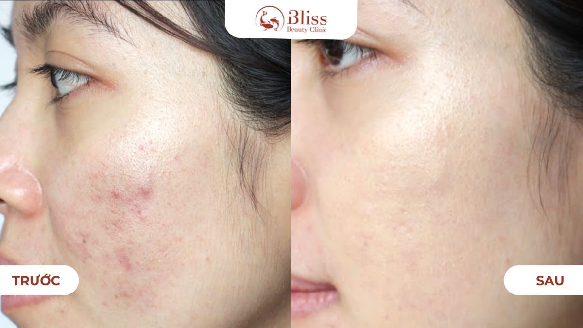 Peel da đất sét Clay Peel 