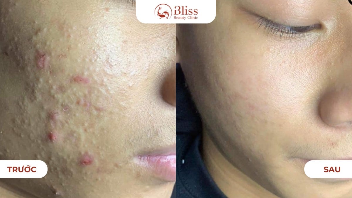 Peel da đất sét Clay Peel 