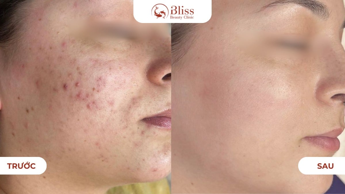 Peel da đất sét Clay Peel 