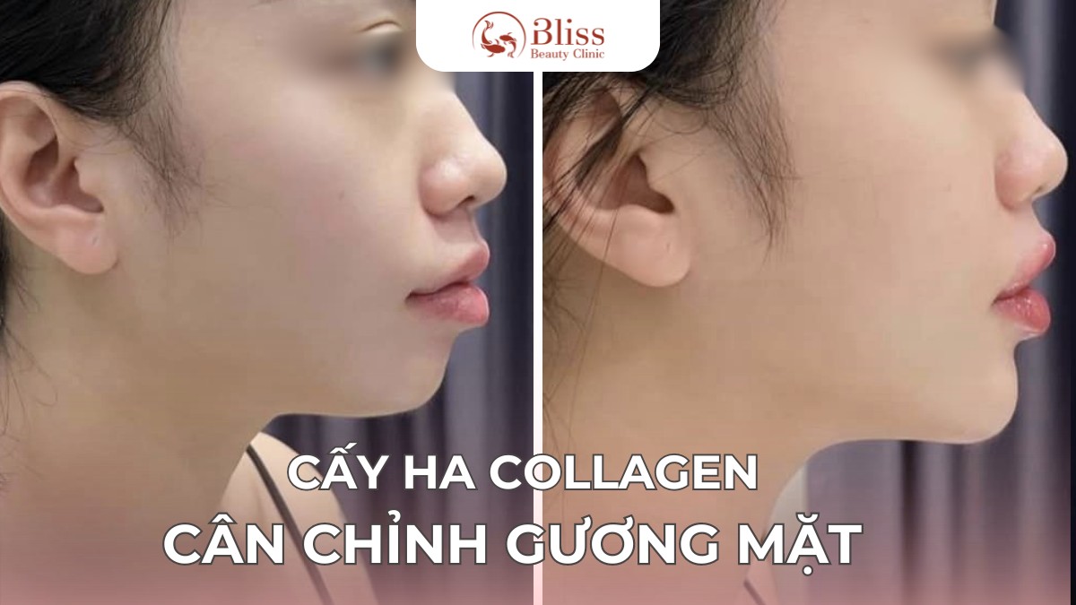 cấy HA Collagen trể hoá
