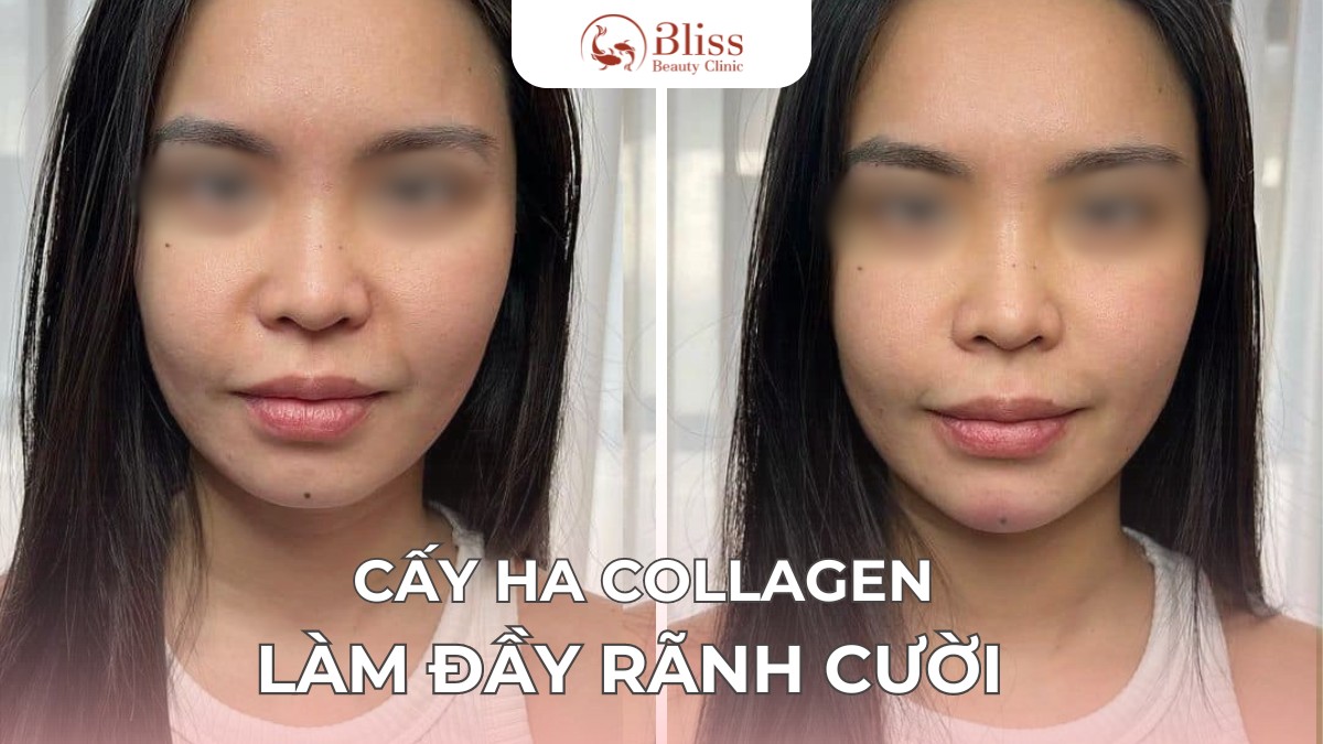cấy HA Collagen trể hoá mặt