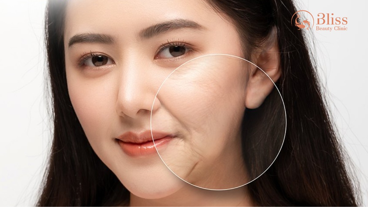 cấy HA Collagen trể hoá