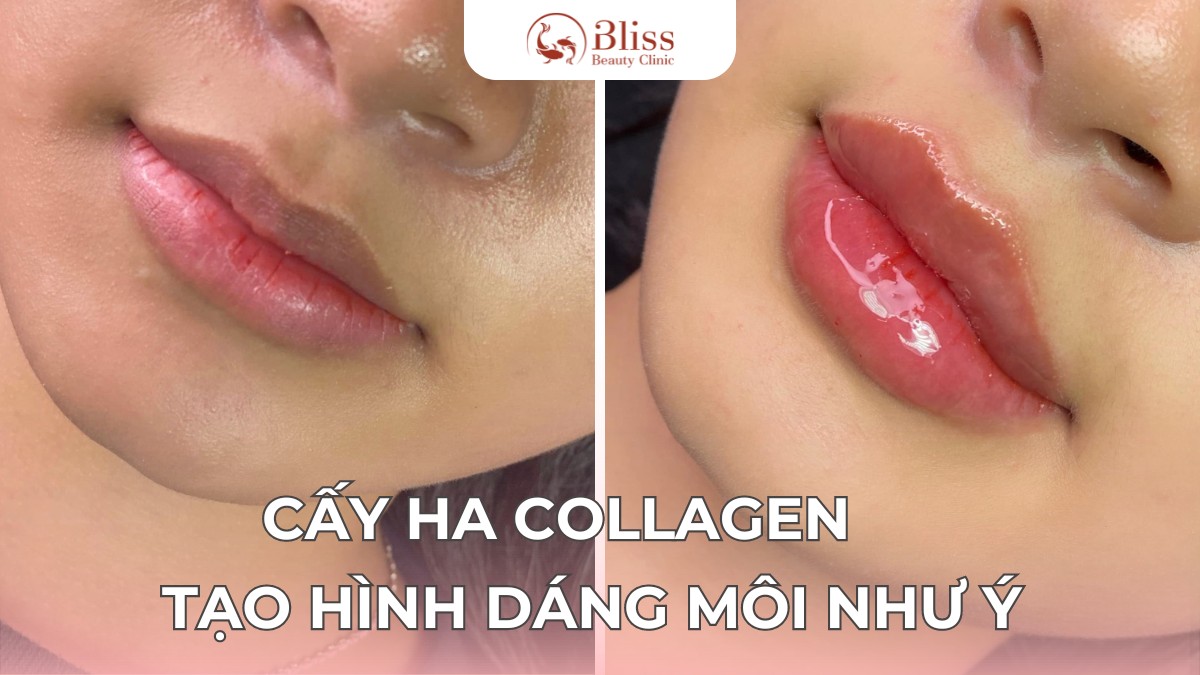 cấy HA Collagen tạo hình môi