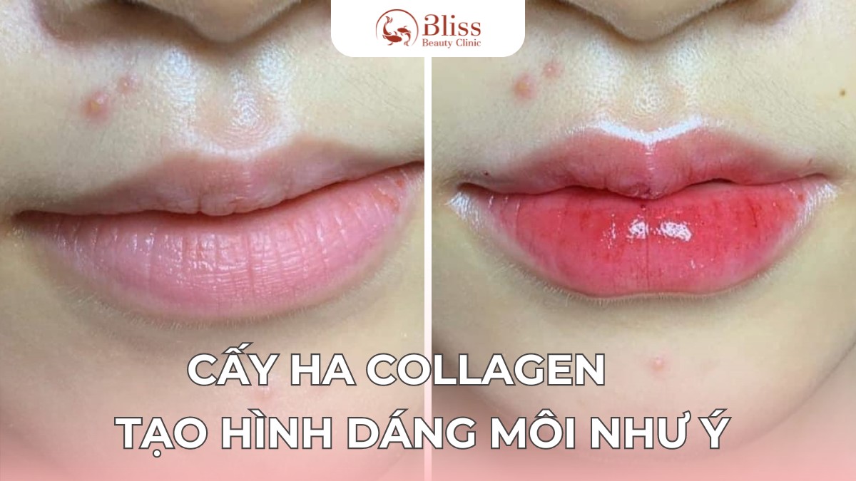 cấy HA Collagen trể hoá môi