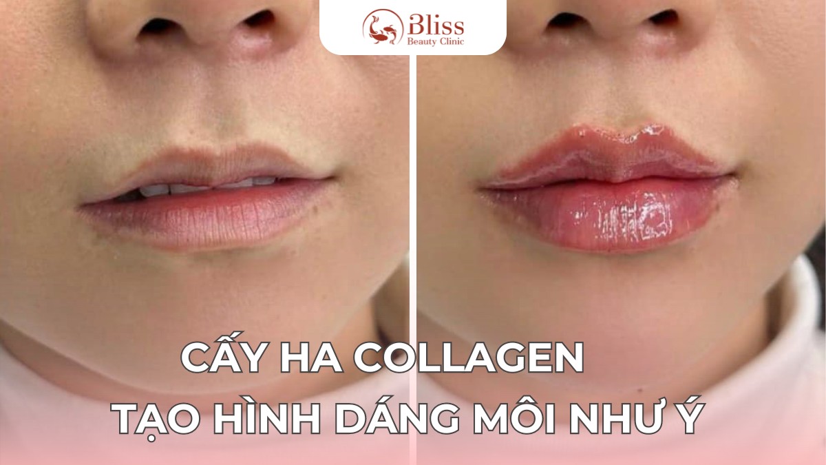 cấy HA Collagen trể hoá môi