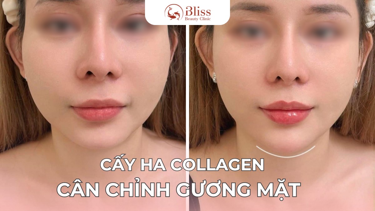 cấy HA Collagen trể hoá cân chỉnh cằm lẹm