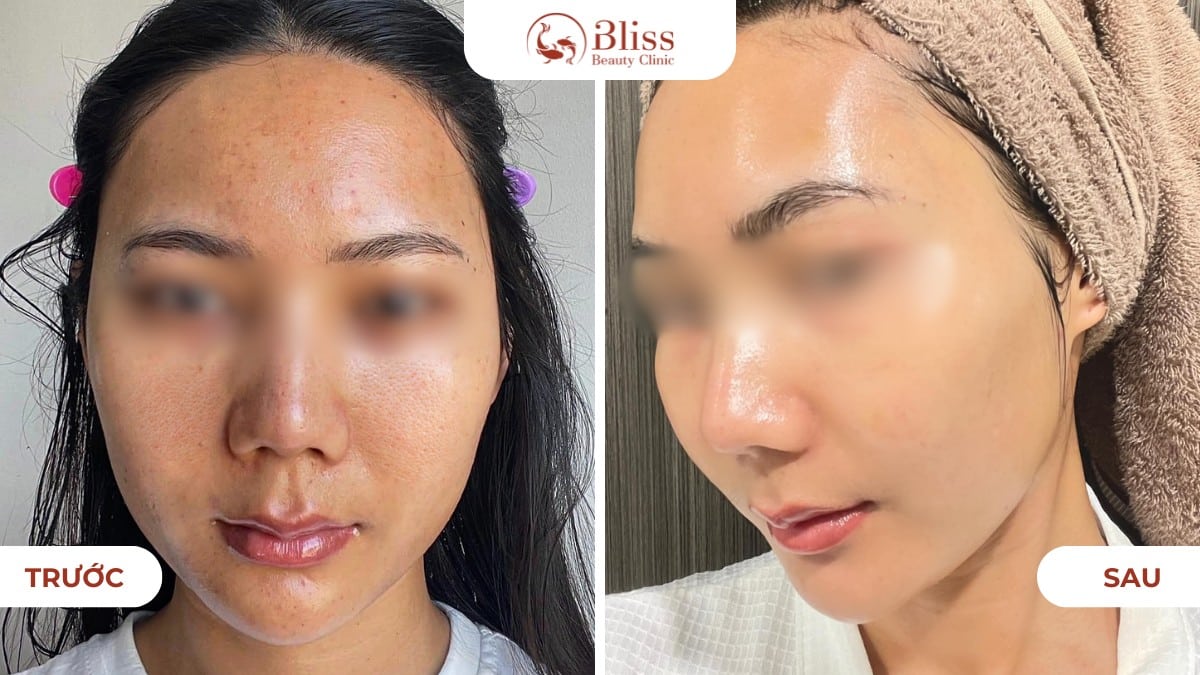 Skin Booster trắng sáng da