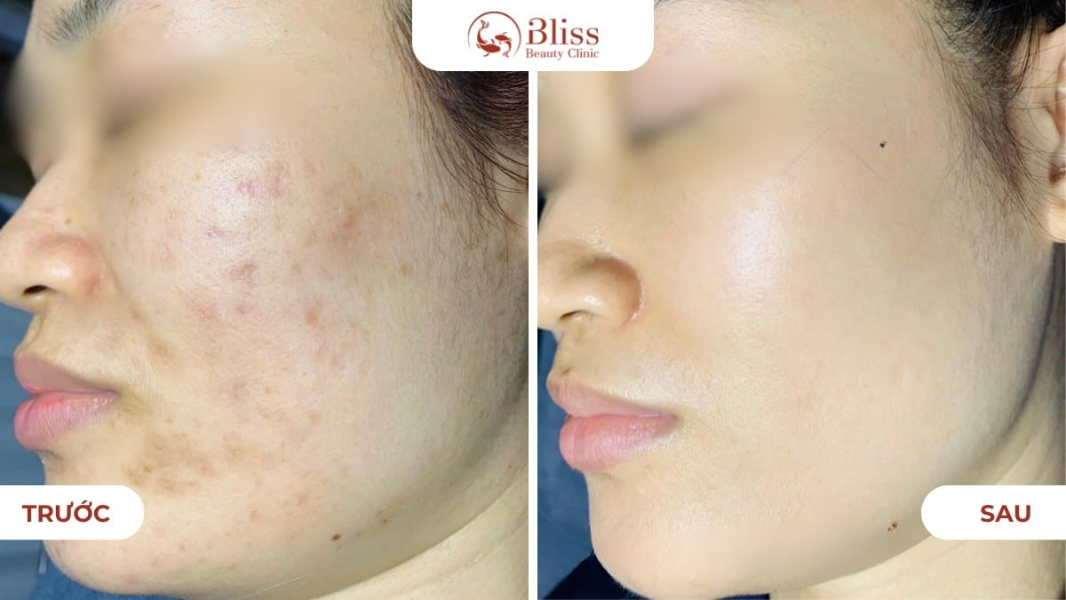 Skin Booster trắng da mờ thâm nám