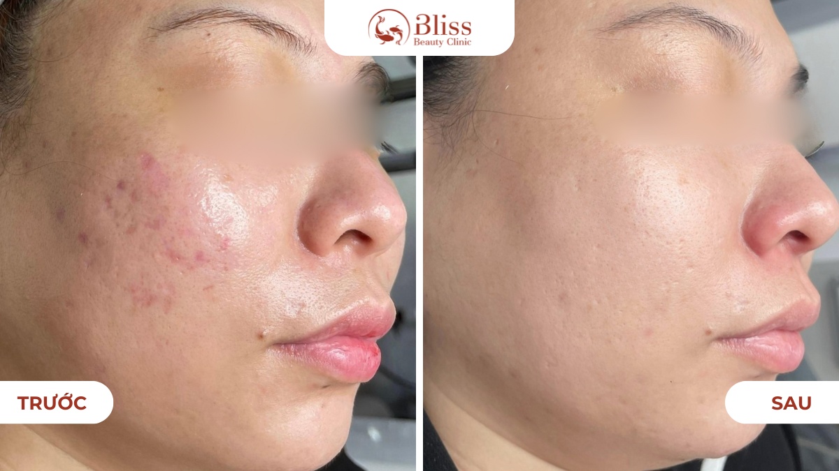 chăm sóc da mụn Hydrogen