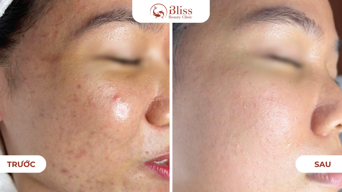 chăm sóc da mụn Hydrogen