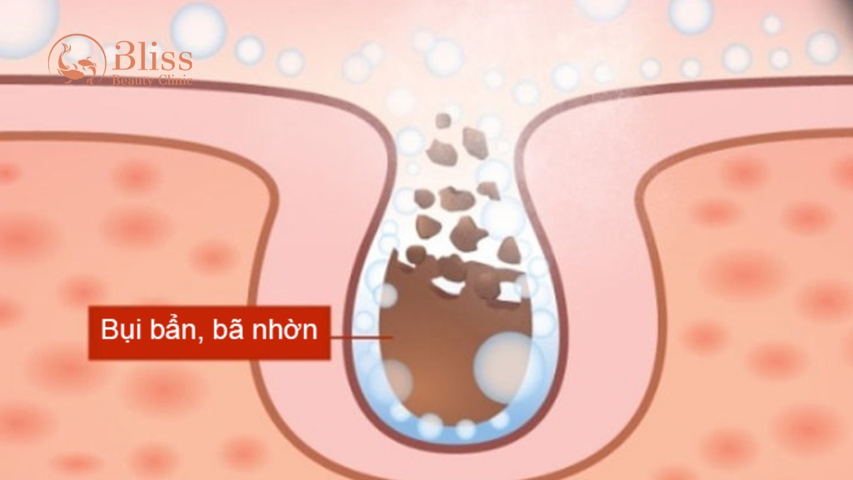 chăm sóc da mụn Hydrogen