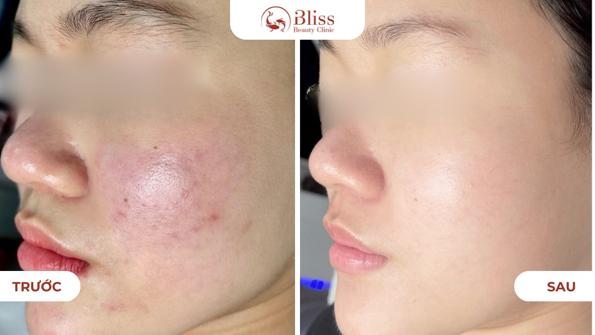 chăm sóc da mụn Hydrogen