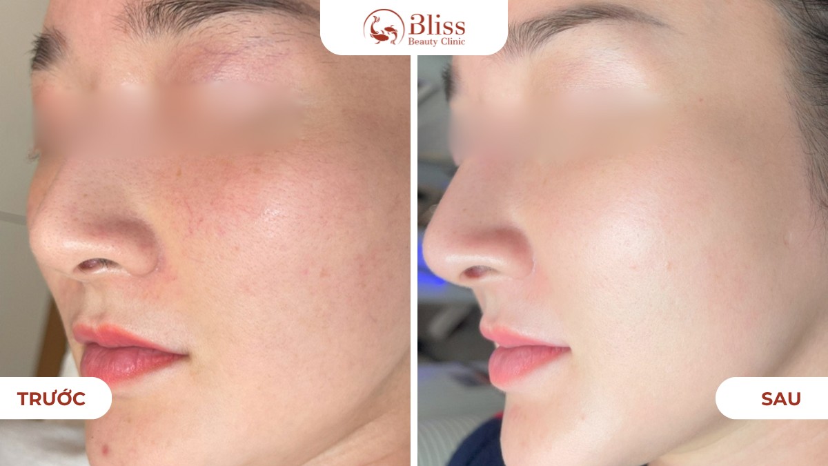 chăm sóc da mụn Hydrogen