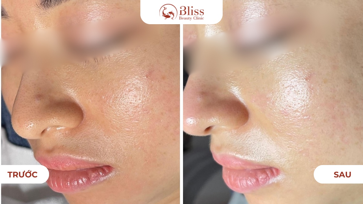 Before - After công nghệ Hydrogen 