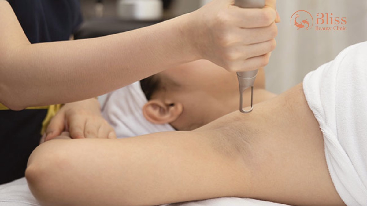 Laser 8D khử thâm nách