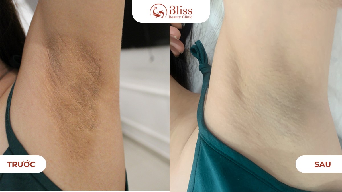 Hiệu quả laser 8d khử thâm body