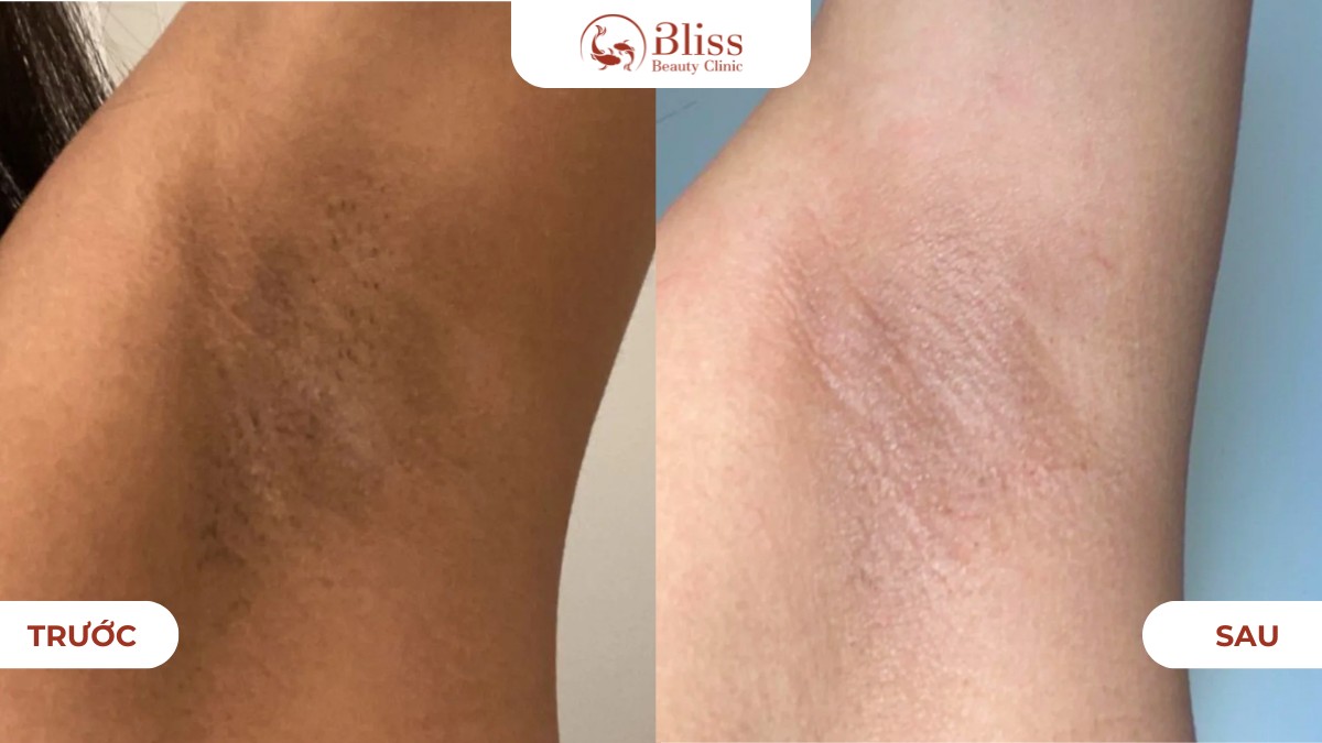 Trước và sau khi khử thâm nách bằng laser 8D