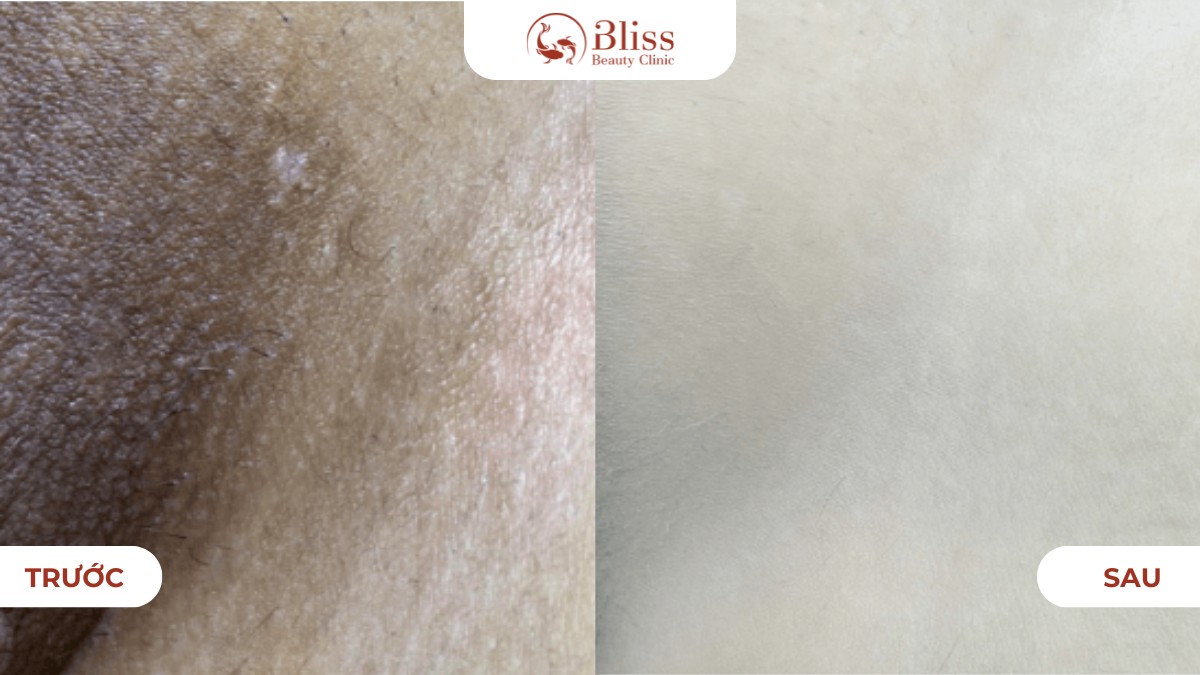 Laser 8D khử thâm bẹn