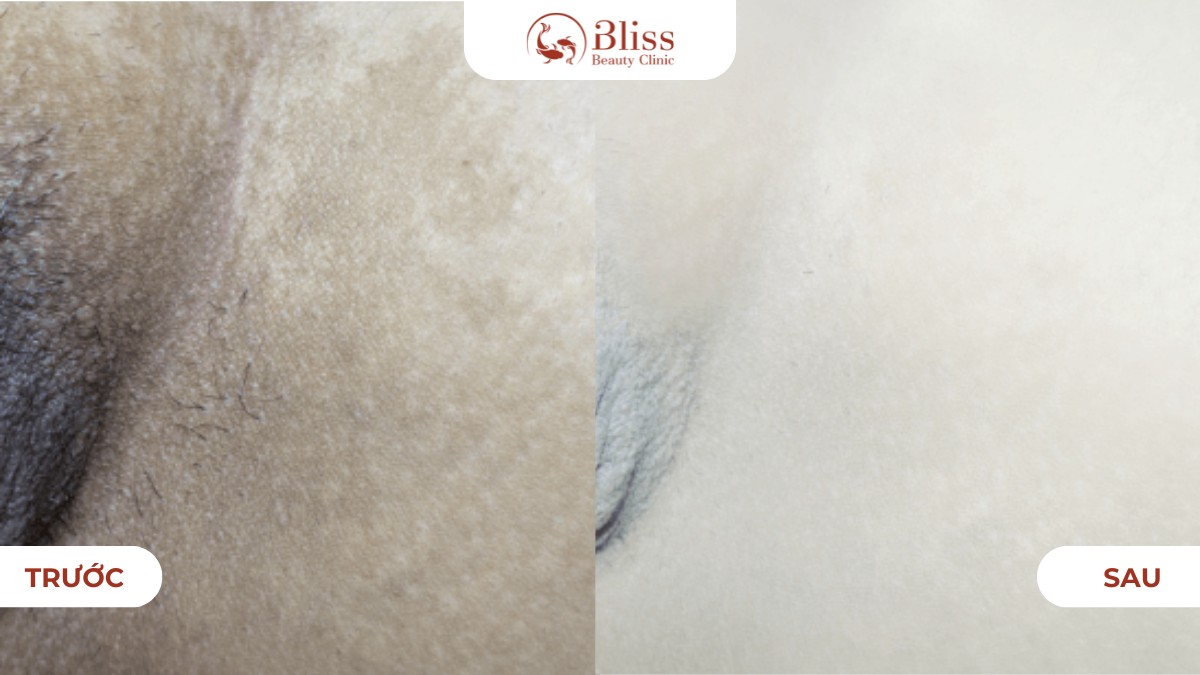 Laser 8D khử thâm mông