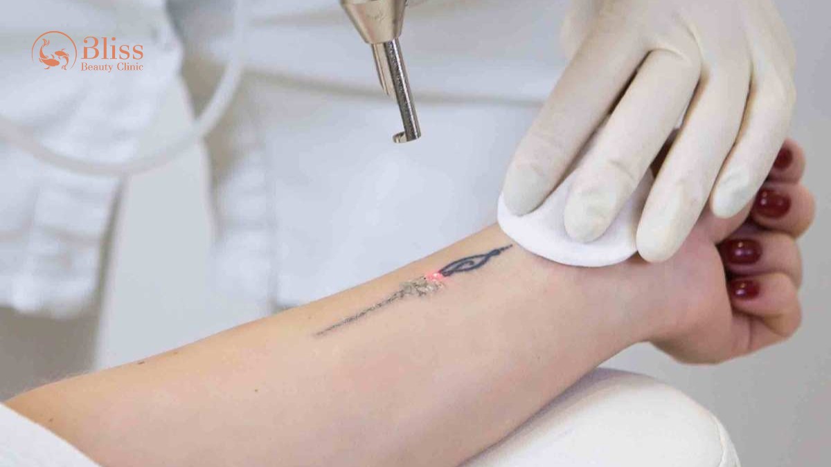 Laser CO2 Fractional xóa xăm