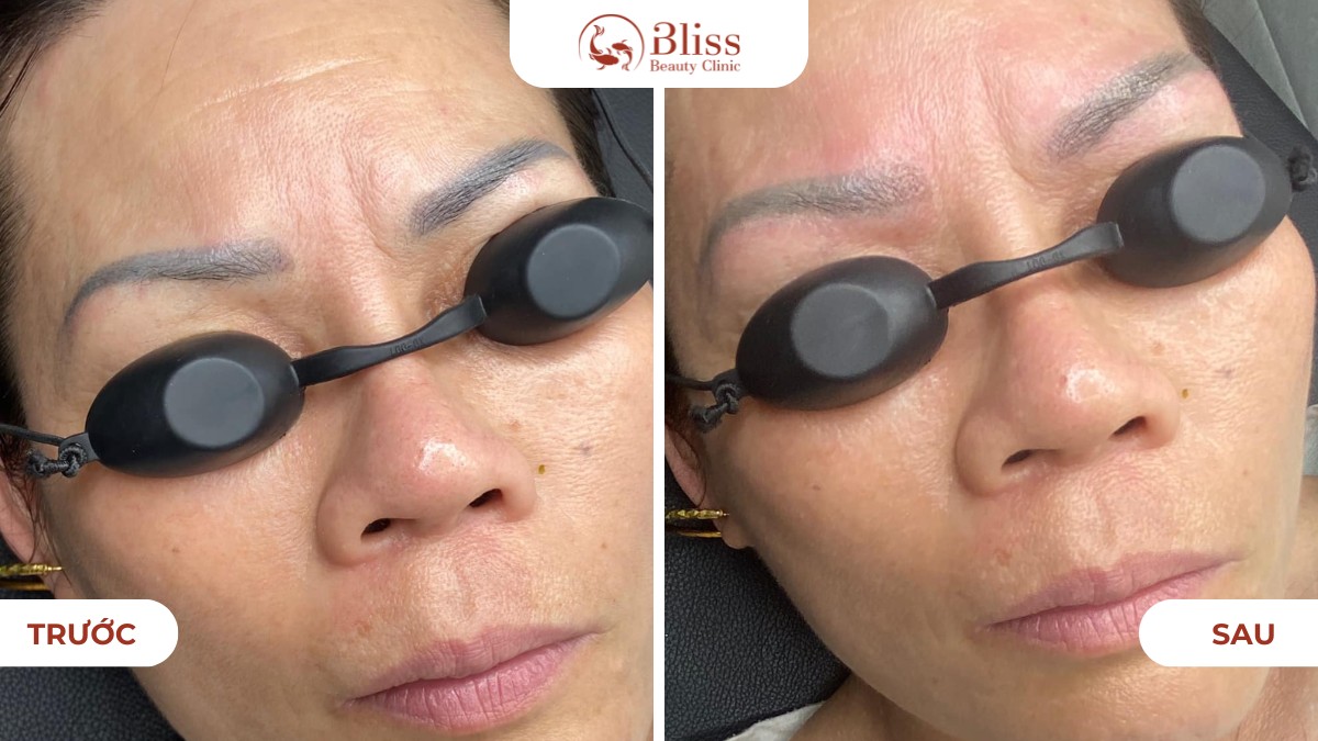 Laser CO2 Fractional xoá xăm chân mày lỗi