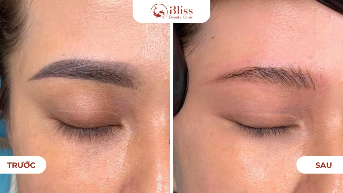 Laser CO2 Fractional xóa xăm