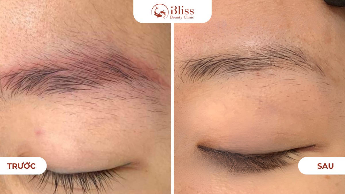 Laser xóa xăm chân mày