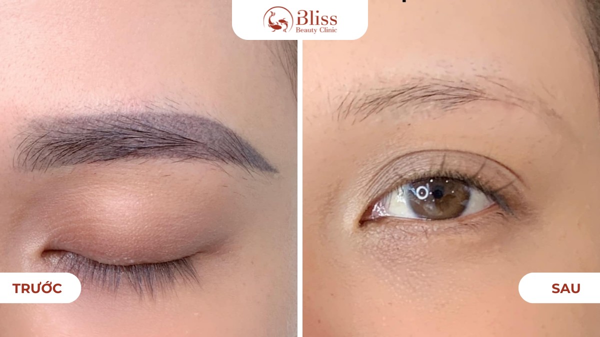 Laser CO2 Fractional xóa xăm