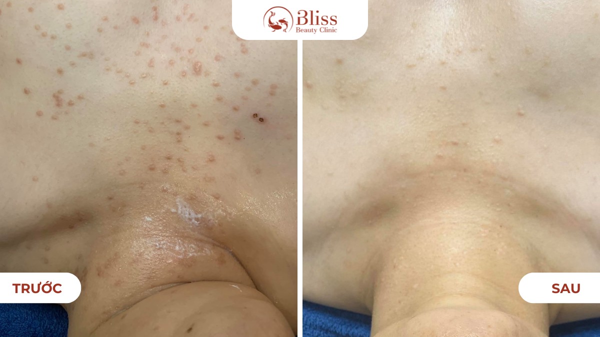 Laser Pico xóa nốt ruồi mụn thịt tận gốc