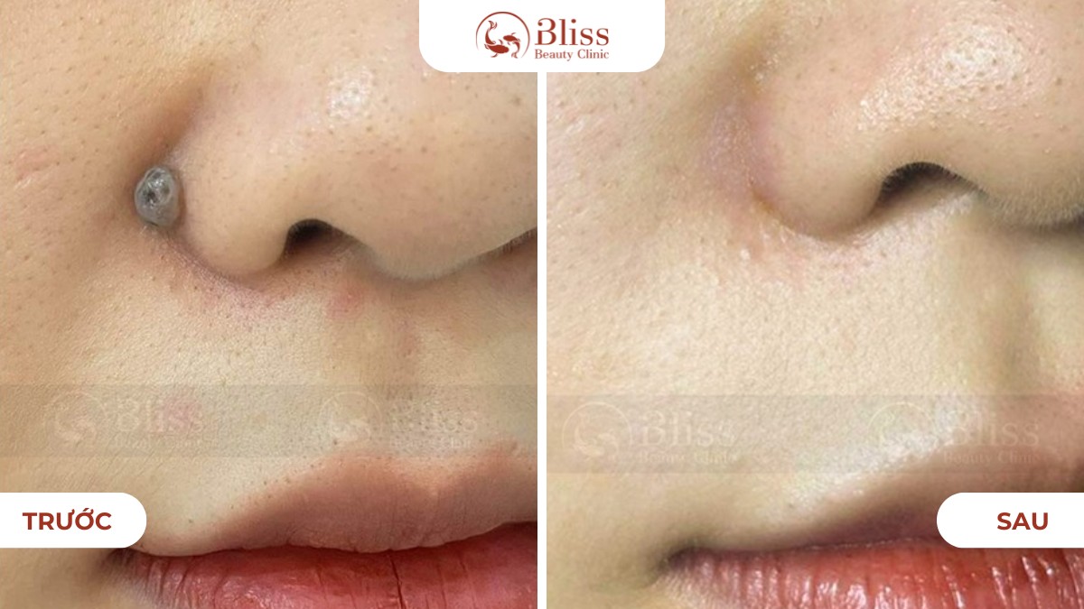 hiệu quả Laser Pico xóa nốt ruồi