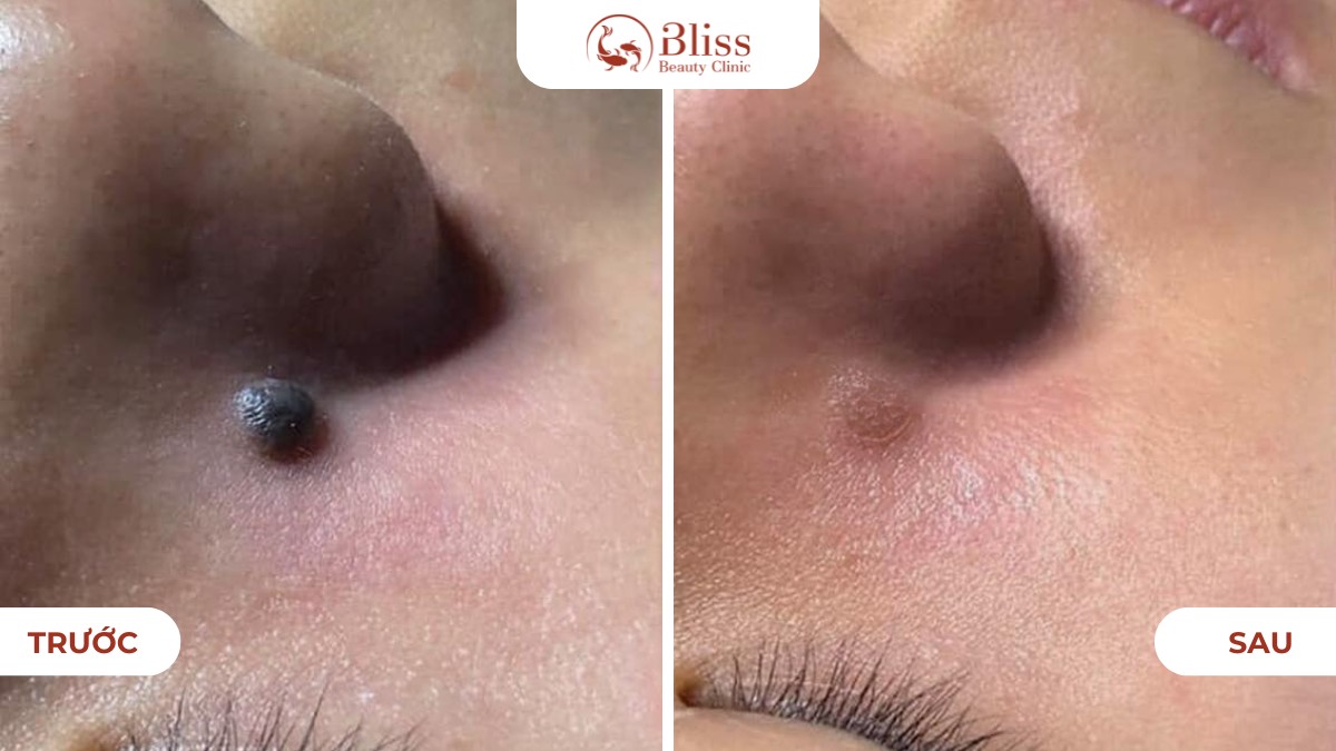 Laser Pico xóa nốt ruồi mụn thịt tận gốc