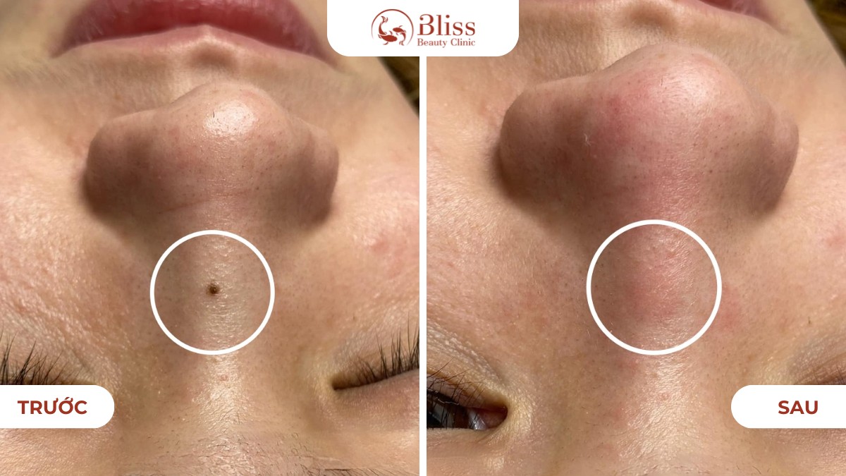 hiệu quả xoá nốt ruồi tại Bliss Beauty