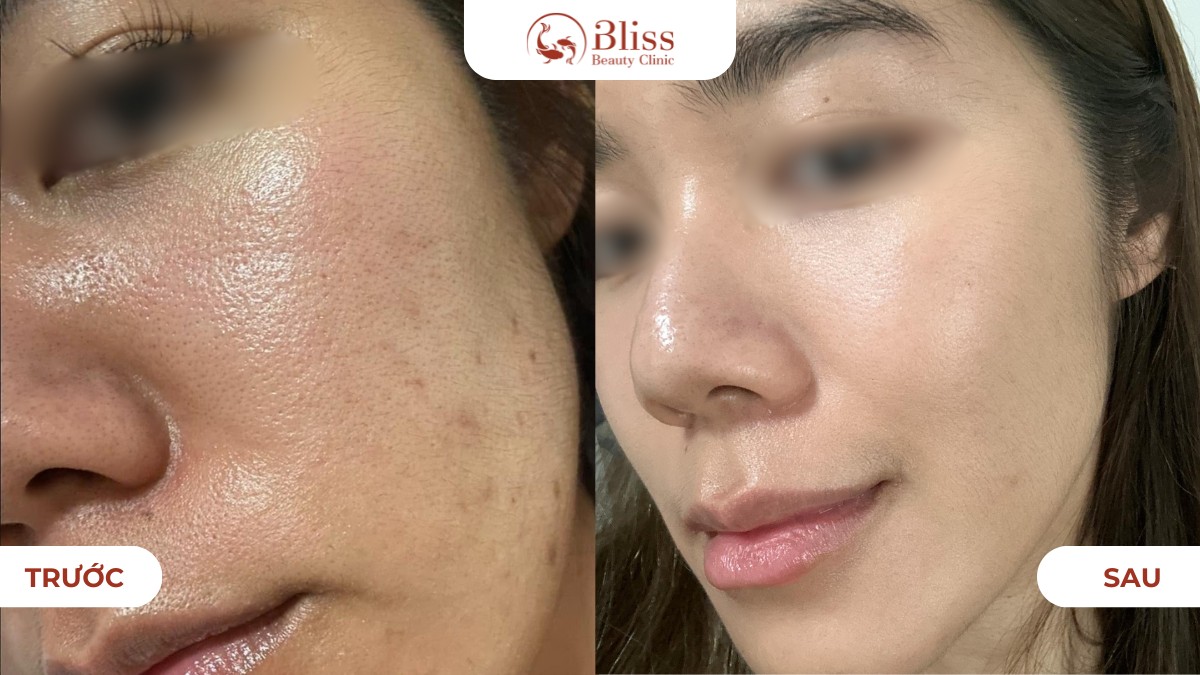 Hiệu quả Laser Toning mờ thâm sáng da