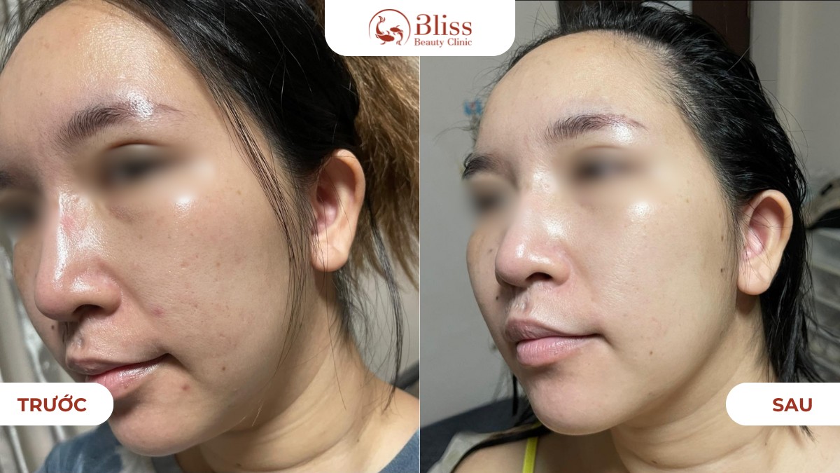 Hiệu quả Laser Toning mờ thâm sáng da