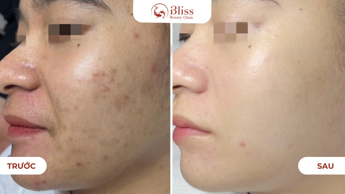 Hiệu quả Laser Toning mờ thâm sáng da