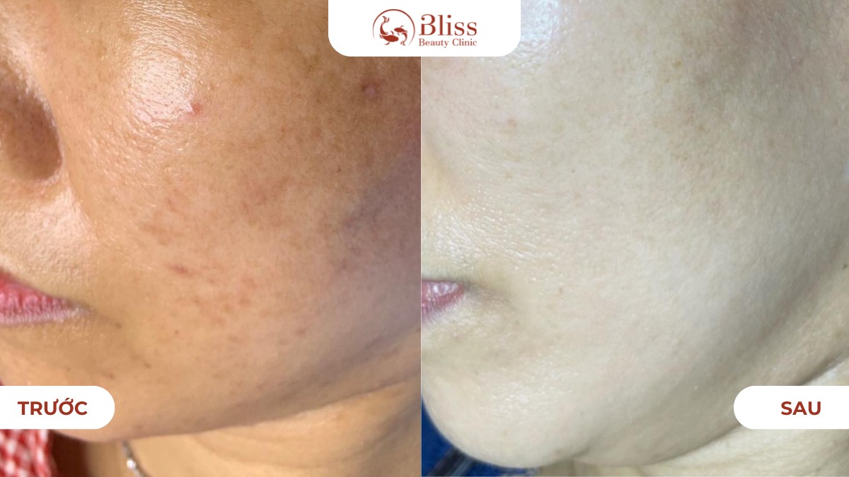 Hiệu quả Laser Toning