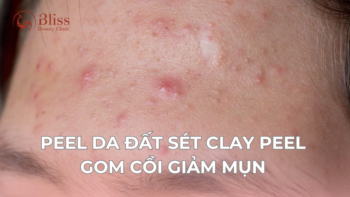 peel da đất sét clay peel