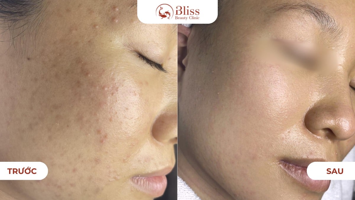 clay peel gom cồi giảm mụn