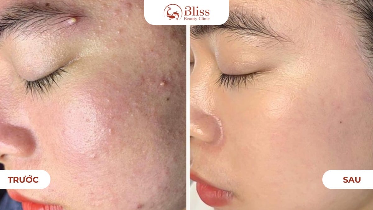 peel da đất sét clay peel