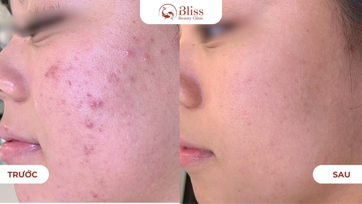 clay peel gom cồi giảm mụn