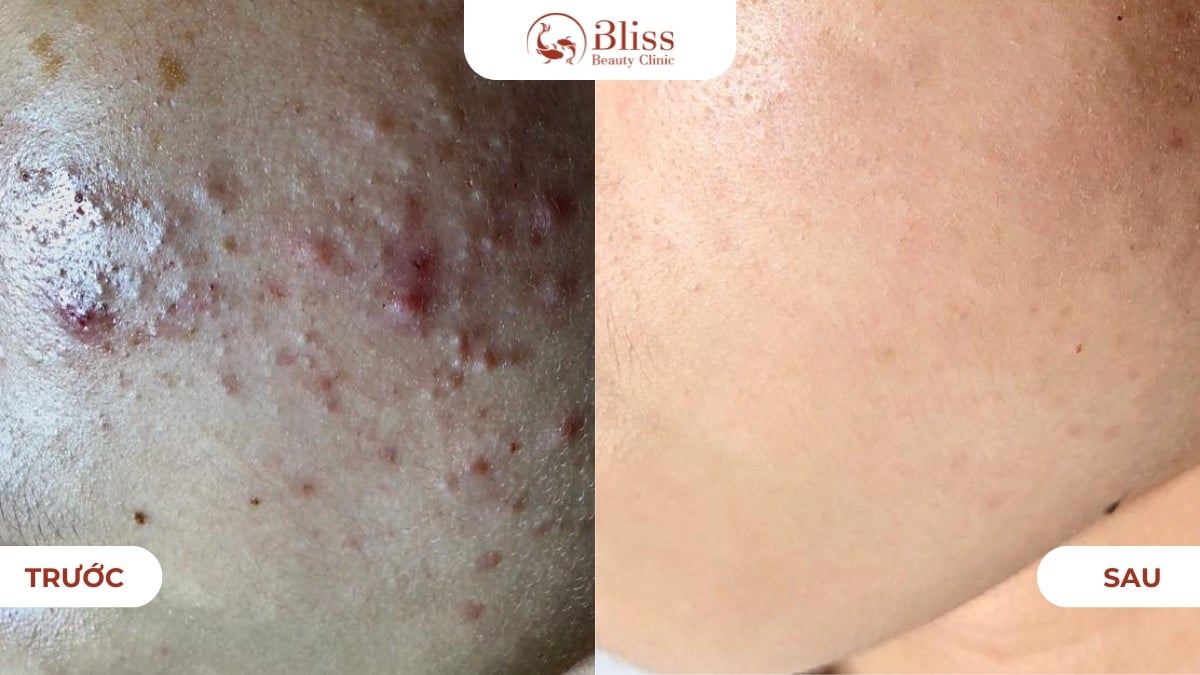 hiệu quả peel da đất sét clay peel