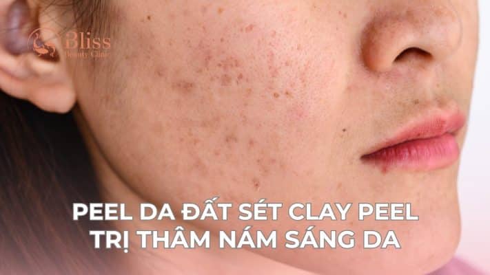 Clay peel trị thâm nám