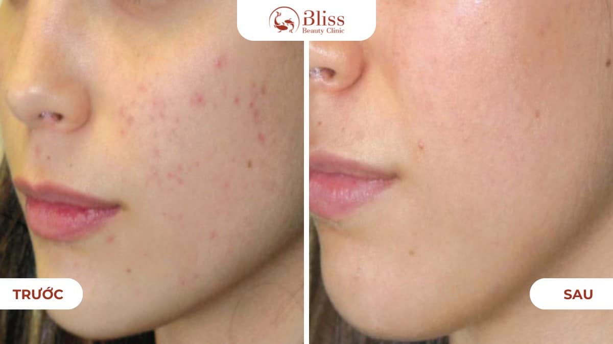 hiệu quả pure skin trị mụn viêm nhẹ - trung bình