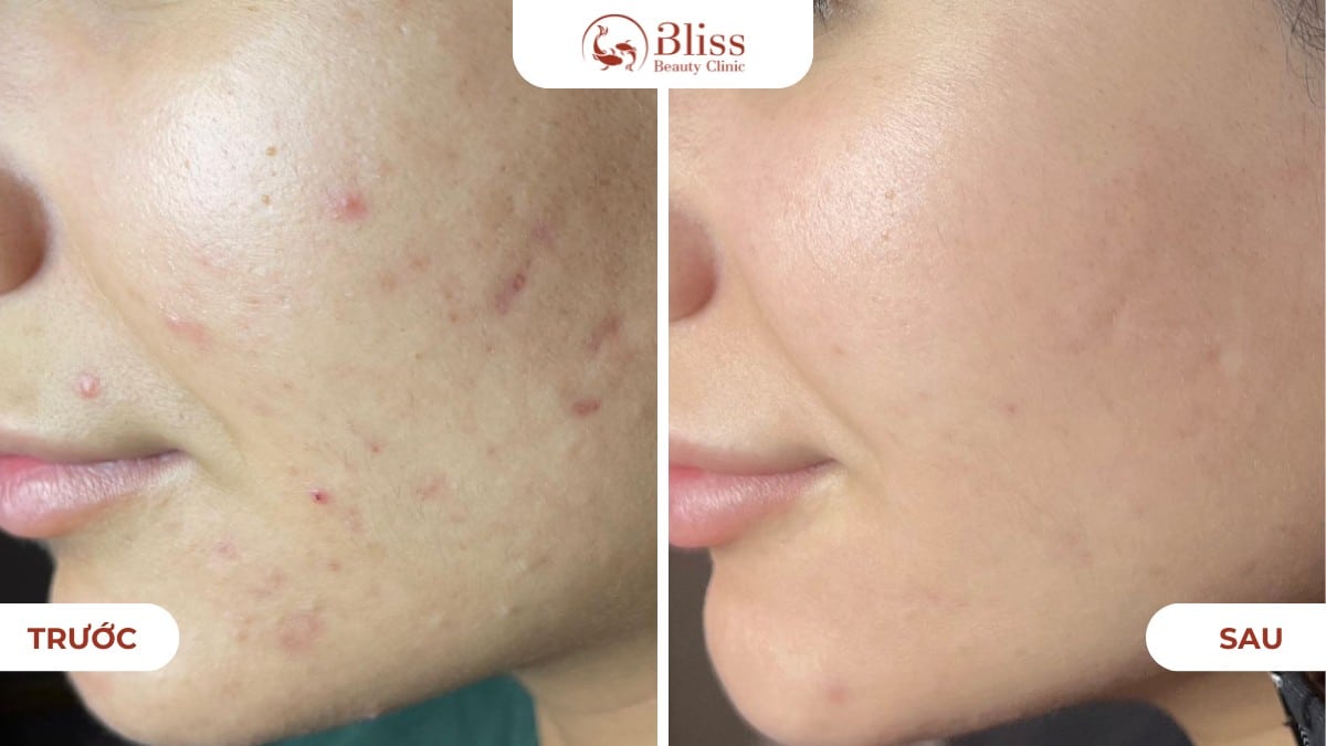 pure skin trị mụn viêm nhẹ