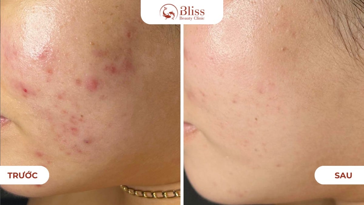 pure skin trị mụn viêm nhẹ